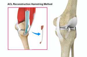 ACL Reconstruction Hamstring Tendon