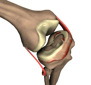 Tear of Meniscus